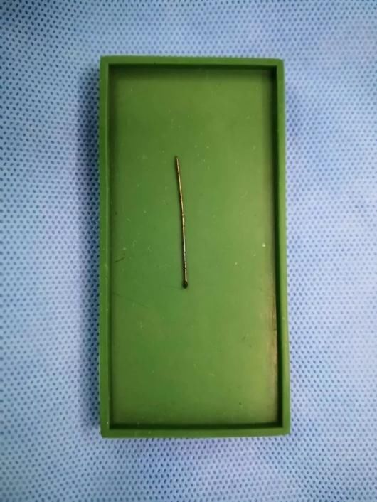 1岁女婴心脏上扎4厘米长针 因妈妈有这个习惯