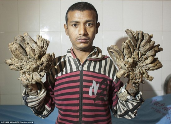 切掉10斤枝状疣