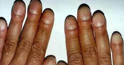 手指有这4种症状,说明身体内又许多毒素,严重