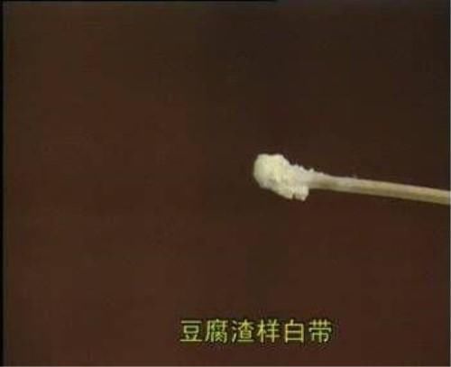 白带带血、像豆腐渣、变黄是怎么了?白带异常