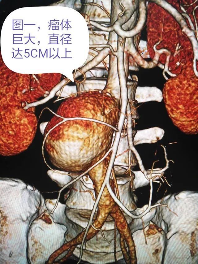 医院普外科与导管室成功为一例巨大腹主动脉瘤