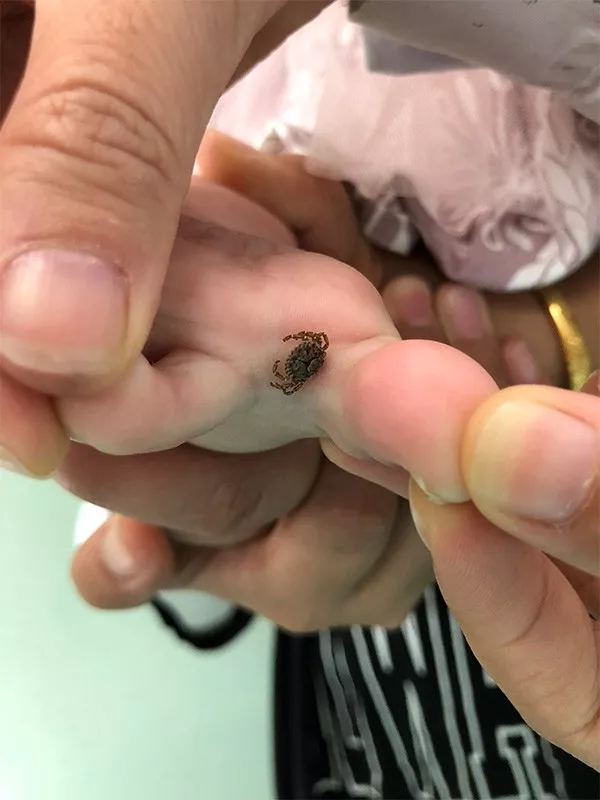 2岁女孩脚趾间多了颗“黑痣”,让人汗毛倒竖! 2岁女孩脚趾间多了颗“黑痣”,让人汗毛倒竖!