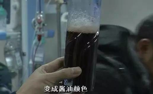 男童排出红褐色酱油尿 就因为吃了怪味豆