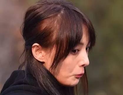 扎头发也有风险 一不下心就会像郑爽金晨一样变秃