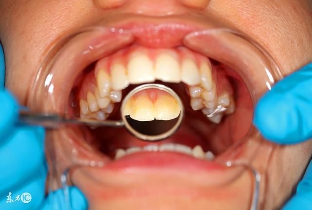 怎么分辨自己是牙龈炎还是牙龈癌,看这三点,别