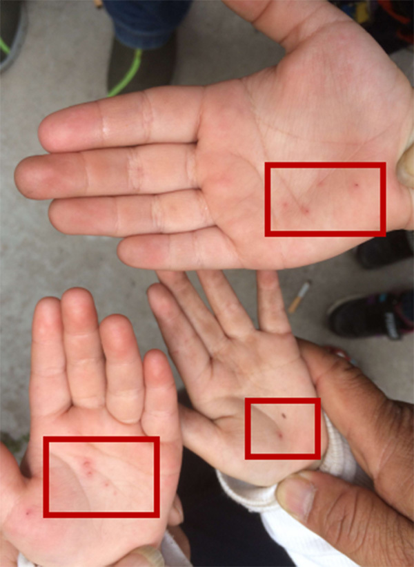 幼儿园女老师针扎20多名幼童 警方正调查 幼儿园女老师针扎20多名幼童 警方正调查