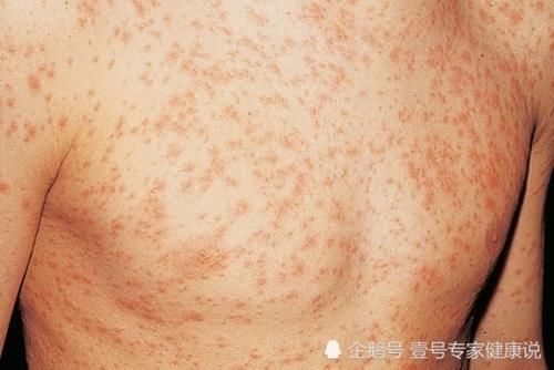 太吓人了,艾滋病早期症状是这样,看完真是怕怕