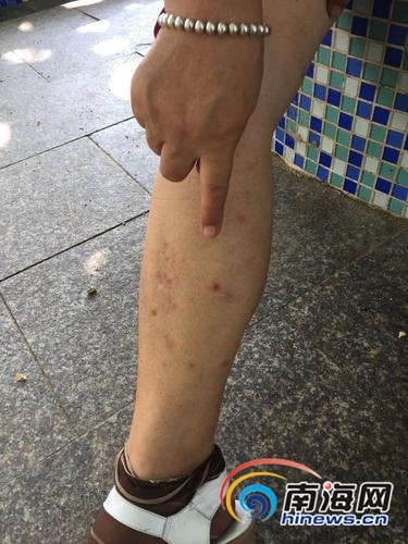 市民反映黑虫子咬人疤痕2个月不消 医生:勿将皮肤直接暴露在外