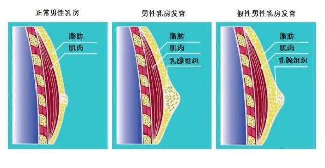 男性乳房发育,往往是以乳头为中心扩展有弹性的或者质硬的肿块,常为