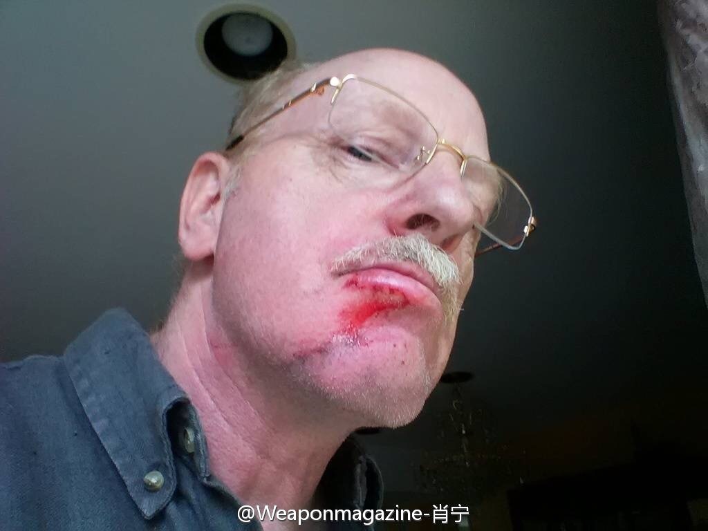 图为外国枪迷的伤口情况。