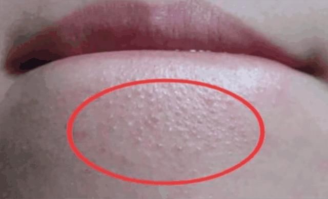 抿嘴后下巴毛孔凸起白米粒!竟是3样丑东西,几