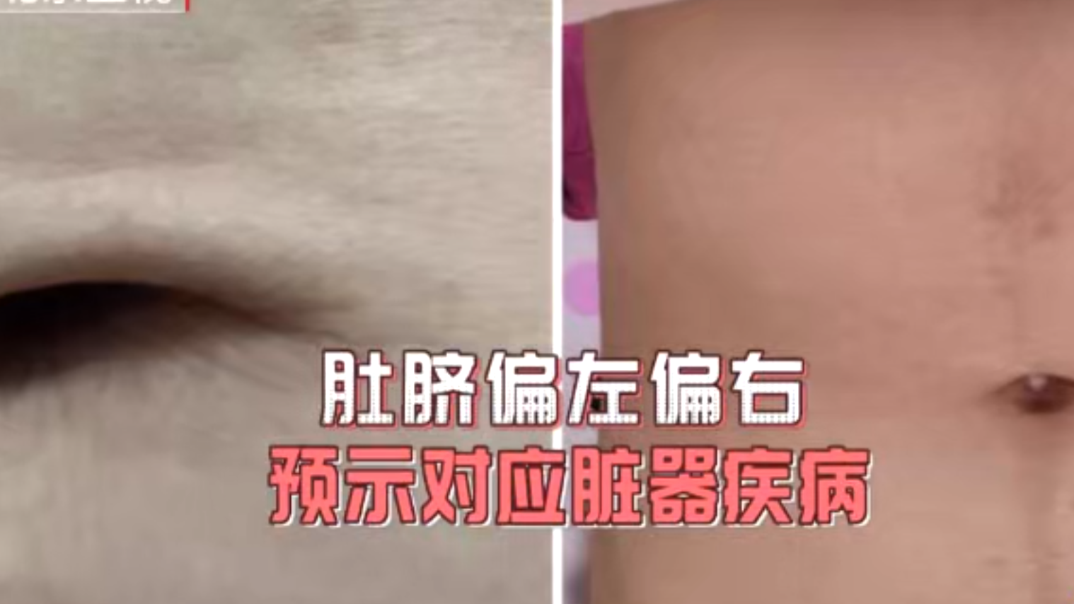 肚脐左右偏移+预示着对应脏器的疾病