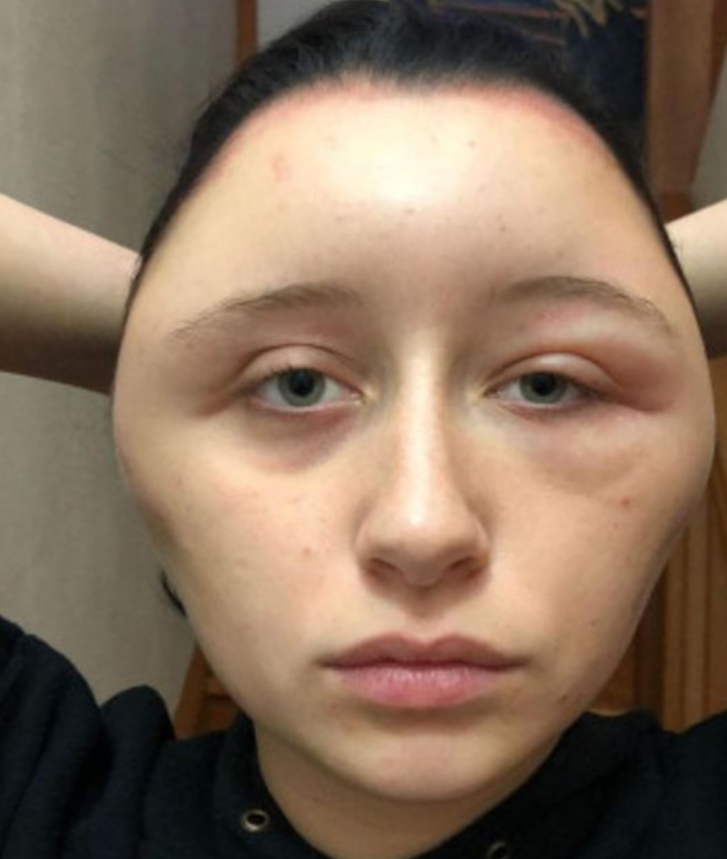 女大学生使用染发剂后过敏 脑袋肿成外星人