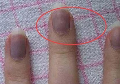 如果你的指甲变成这样,不是大病就是癌,最好上医院检查一下!