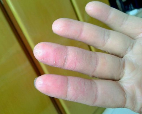 真菌感染引起的手癣怎么治?价值数万的秘籍马