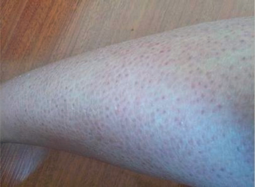 蛇皮肤怎样可以去掉?注意小细节轻松展现光滑