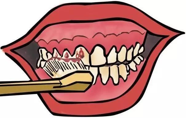 蛀牙真的是吃糖导致的?牙齿发黄、牙疼、牙龈