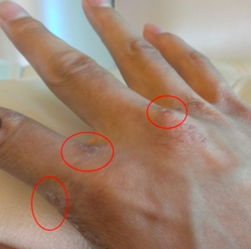 水疱型手癣怎么可以治好?只需做好两步