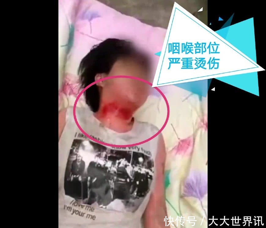 母亲与人私奔,17岁女孩遭对方妻子报复,被开水