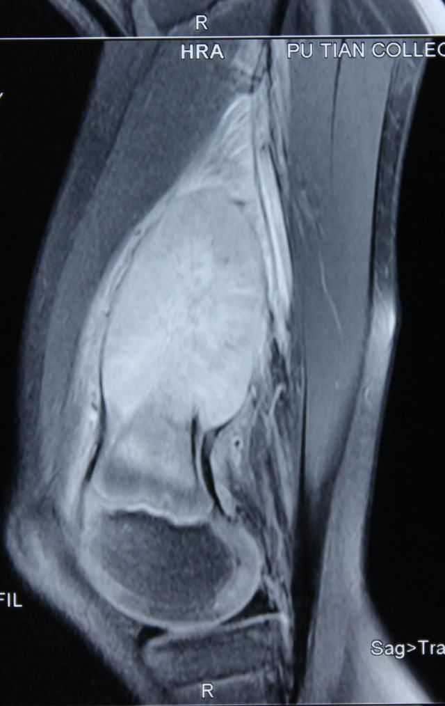 因为睡觉总是腿痛,我住院了…