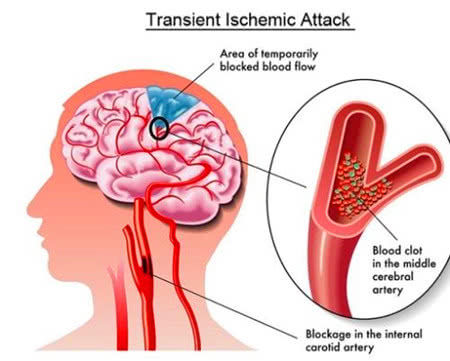 使动脉血管变窄或闭塞,心肌供血不足造成的