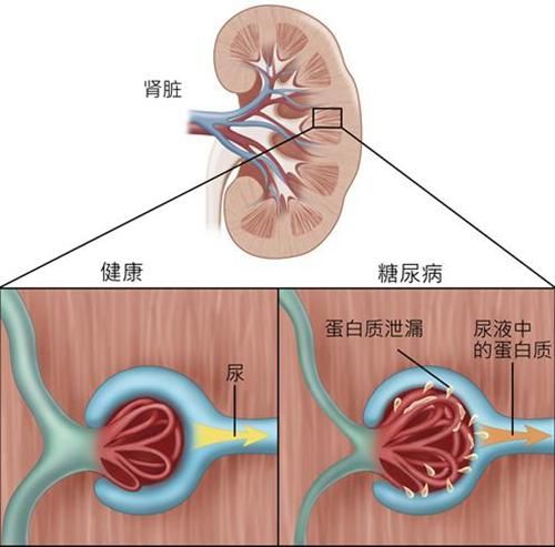糖尿病患者却因肾衰竭而致命,提前发现这6大症状,能救你一命!