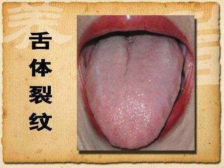 出现口腔溃疡,心中过于烦躁,那么这种症状就是典型的阴虚火旺的症状