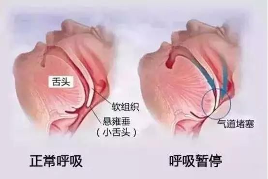 健康警报 打呼噜可不是小事!