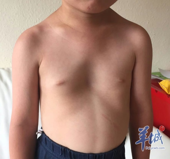 鸡胸漏斗胸……影响心脏就得尽早手术