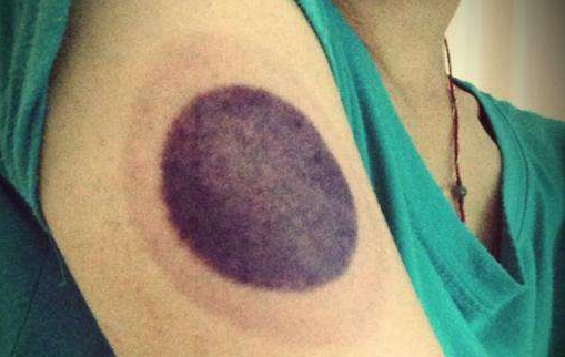 拔火罐对身体好,9种罐印又可以反映出9种体质