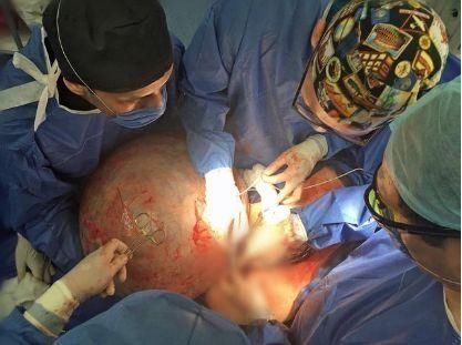 女子怀孕十月,医生以为多胞胎,刨开肚子医生感觉不可思议!