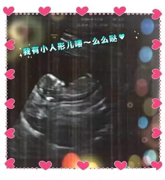 孕期检查:排查胎儿畸形,5项检查不可少!