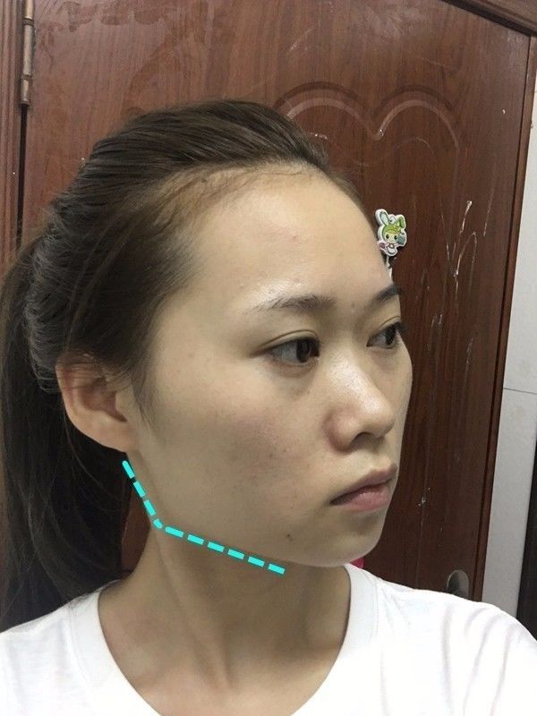 杨幂视频变脸,难道是切下颌骨后遗症?