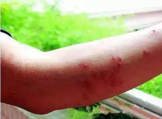 警惕!路遇这种小土堆赶紧躲远点 已有多人被咬伤