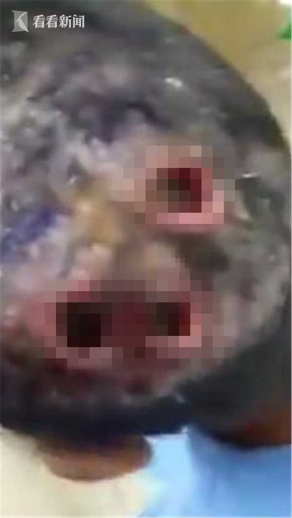 反胃的视频,医生从一名头上有3个非常大血洞的男子头上夹出一条条活蛆
