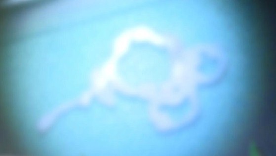 大脑中取出11厘米寄生虫!手部伤口爬入折磨两年之久 大脑中取出11厘米寄生虫!手部伤口爬入折磨两年之久