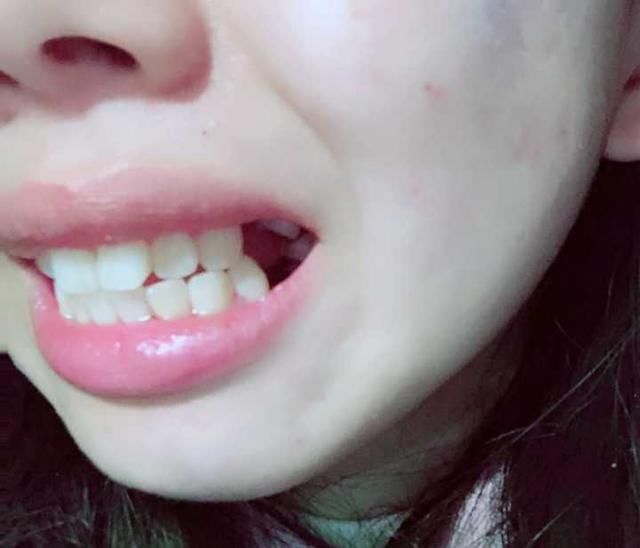 牙套小萌新的整牙日记:龅牙,短下巴,拔四颗牙