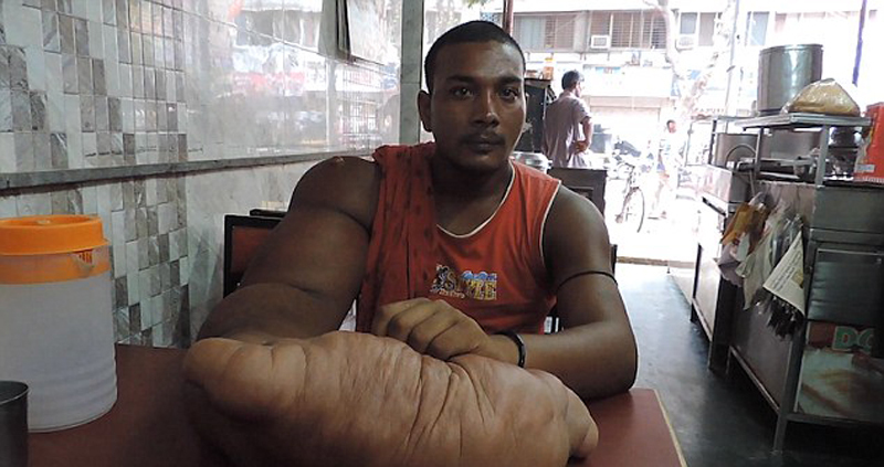 印度男子长出巨人手臂 被称"恶魔之子"