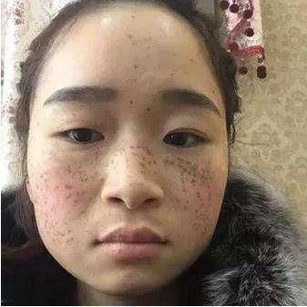 药店里一种药膏,加入白醋洗脸、祛斑