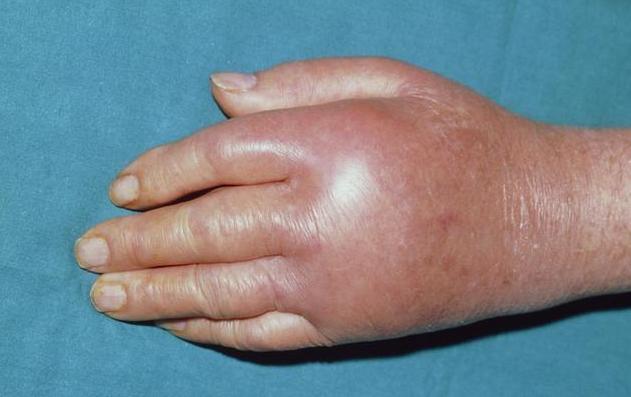 尿酸高一定就是痛风吗?满足这2点才会出现痛