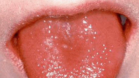 猩红热高发！出现这些症状要当心——