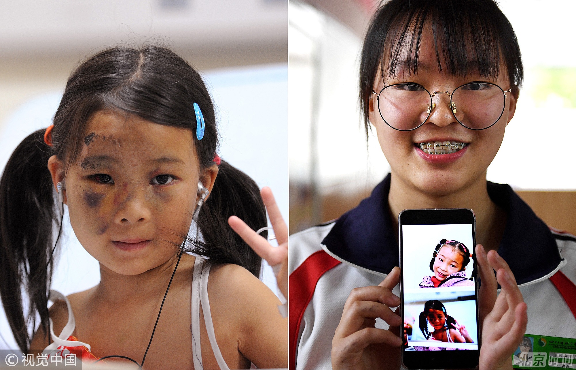 汶川地震十年后的他与他们:地震发生时,5岁尚迪眼睛充血,右手粉碎性骨折,1由于被困100小时,她双腿被截肢,左眼失明。当时,尽管遭受如此磨难,5岁的尚迪当时还是勇敢地向摄影师打出了“V”字手势。十年后,尚迪说,自己现在最大的愿望就是考上医科院校,当一名医生,回到当地为家人,为当地人治病。