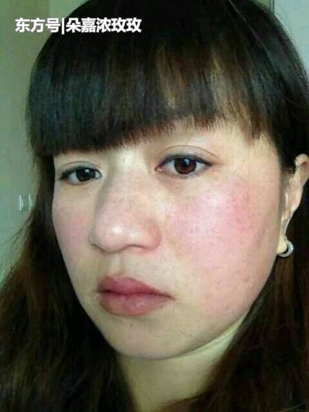 激素脸再修复过程中干燥脱皮是好是坏,激素脸