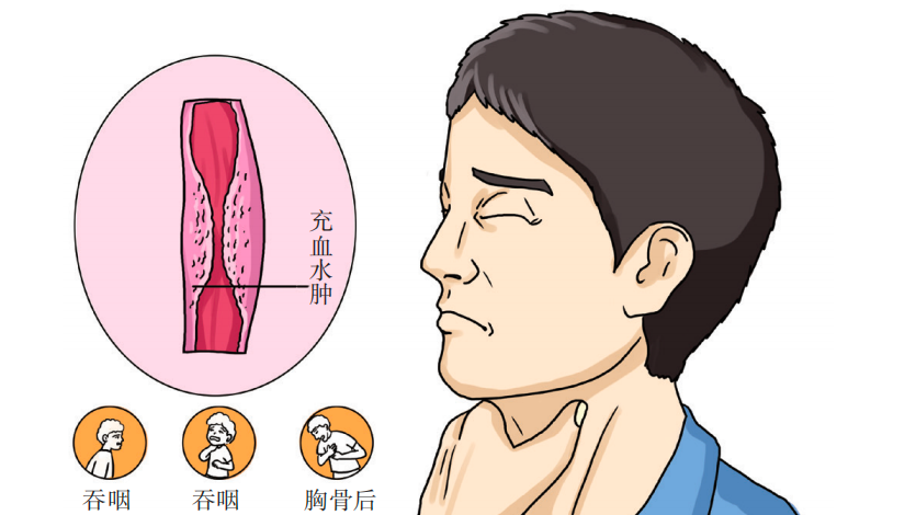 “吃出来”的癌症！喉咙出现这4种症状，可能是预警……