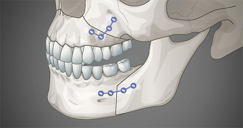 韩国做双鄂手术费用一般是多少?
