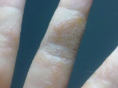 湿疹有哪些症状,九大湿疹即九大症状!