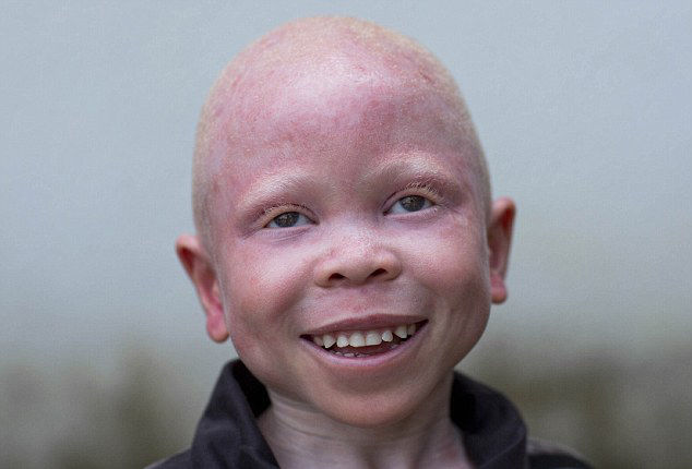 世界上最"可怜"的人,被视为异类,不少人抢夺其血液