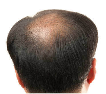 脱发去医院该挂什么科?