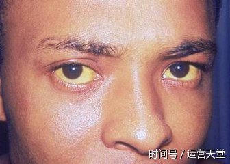 除了蜘蛛痣和肝掌,还有哪些表现能够直接看出