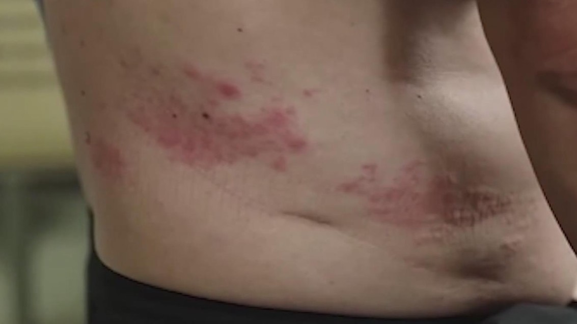 带状疱疹引发神经痛比“生娃”还疼!超9成人体内有水痘带状疱疹病毒 带状疱疹引发神经痛比“生娃”还疼!超9成人体内有水痘带状疱疹病毒